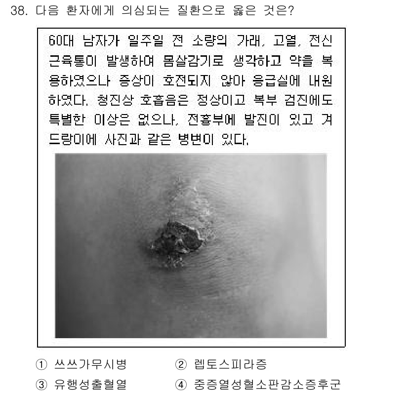 소방공무원(경력)_응급처치학개론 2024년 38번 - . 

이 질환은 주로 지속적인 기침과 호흡곤란을 유발하며, 전신적인 증... 에 관한 핵심 기출문제